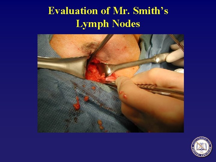 Evaluation of Mr. Smith’s Lymph Nodes 