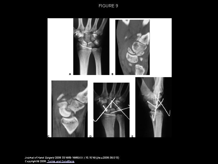 FIGURE 9 Journal of Hand Surgery 2008 331659 -1668 DOI: (10. 1016/j. jhsa. 2008.
