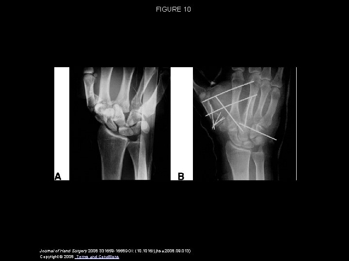 FIGURE 10 Journal of Hand Surgery 2008 331659 -1668 DOI: (10. 1016/j. jhsa. 2008.