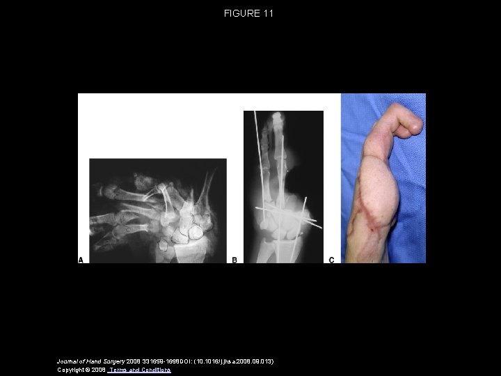 FIGURE 11 Journal of Hand Surgery 2008 331659 -1668 DOI: (10. 1016/j. jhsa. 2008.
