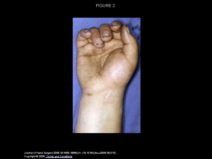 FIGURE 2 Journal of Hand Surgery 2008 331659 -1668 DOI: (10. 1016/j. jhsa. 2008.