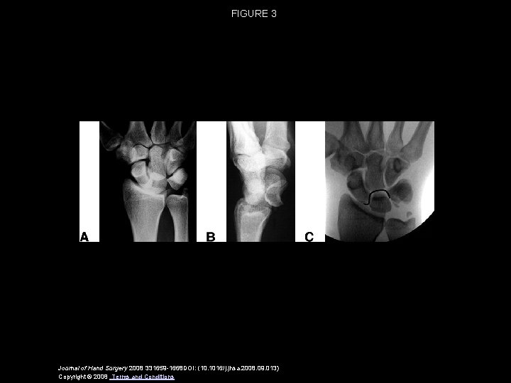FIGURE 3 Journal of Hand Surgery 2008 331659 -1668 DOI: (10. 1016/j. jhsa. 2008.