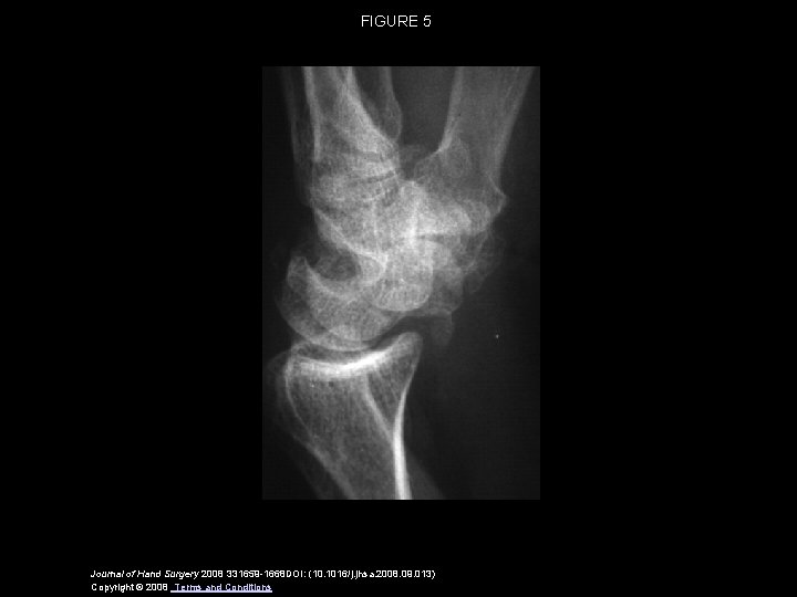 FIGURE 5 Journal of Hand Surgery 2008 331659 -1668 DOI: (10. 1016/j. jhsa. 2008.