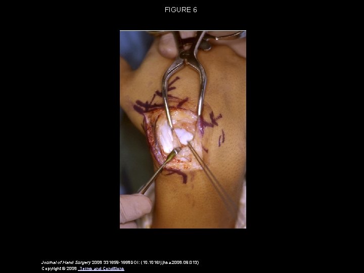FIGURE 6 Journal of Hand Surgery 2008 331659 -1668 DOI: (10. 1016/j. jhsa. 2008.