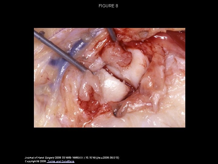 FIGURE 8 Journal of Hand Surgery 2008 331659 -1668 DOI: (10. 1016/j. jhsa. 2008.
