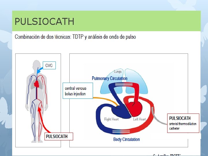 PULSIOCATH 