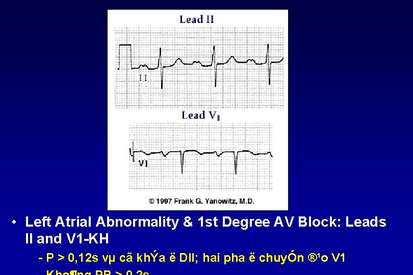  • Left Atrial Abnormality & 1 st Degree AV Block: Leads II and