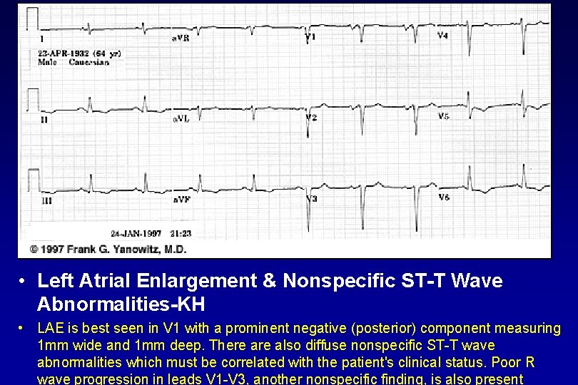  • Left Atrial Enlargement & Nonspecific ST T Wave Abnormalities KH • LAE