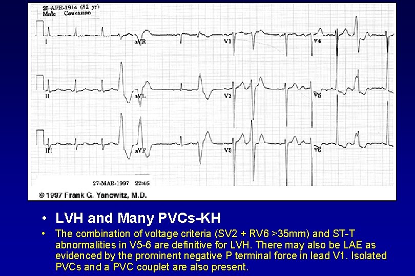  • LVH and Many PVCs KH • The combination of voltage criteria (SV