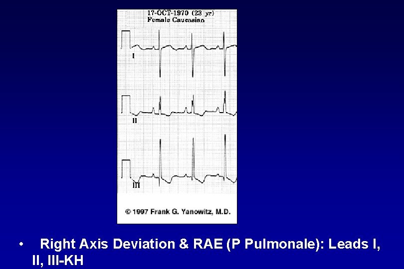  • Right Axis Deviation & RAE (P Pulmonale): Leads I, III KH 