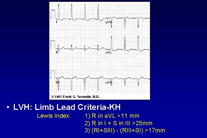  • LVH: Limb Lead Criteria KH Lewis Index: 1) R in a. VL