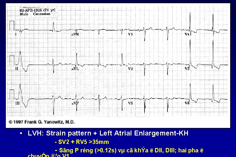  • LVH: Strain pattern + Left Atrial Enlargement KH SV 2 + RV