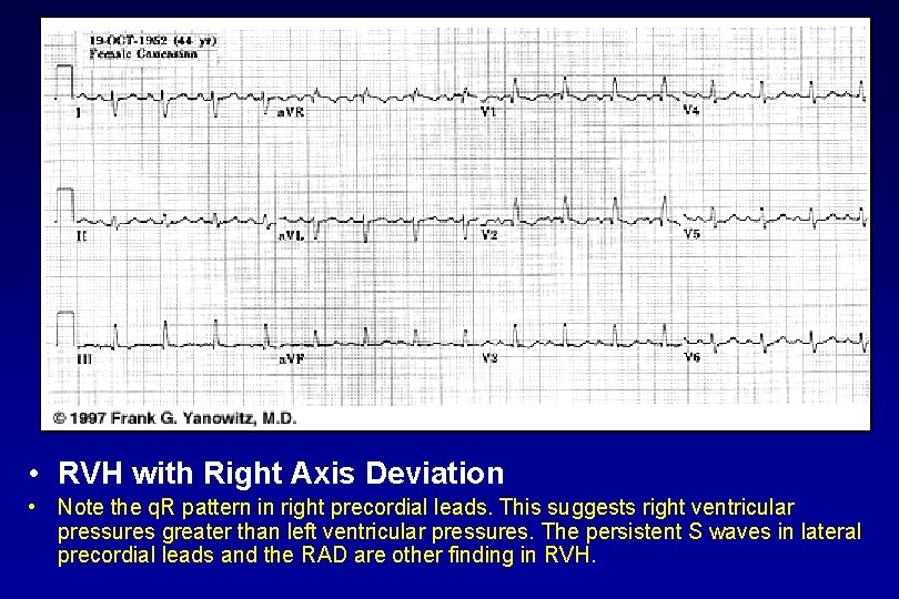  • RVH with Right Axis Deviation • Note the q. R pattern in