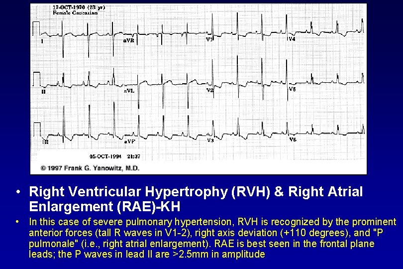  • Right Ventricular Hypertrophy (RVH) & Right Atrial Enlargement (RAE) KH • In