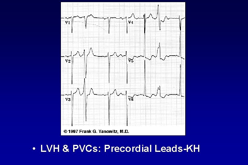  • LVH & PVCs: Precordial Leads KH 