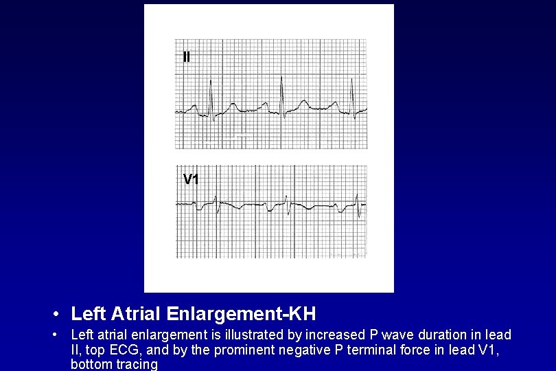 II V 1 • Left Atrial Enlargement KH • Left atrial enlargement is illustrated