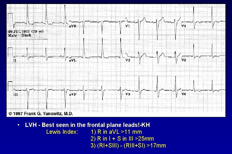  • LVH Best seen in the frontal plane leads! KH Lewis Index: 1)