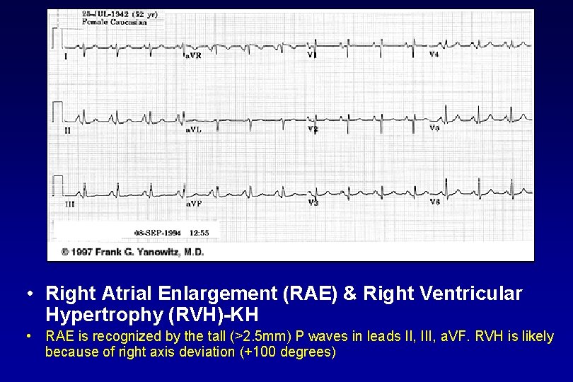  • Right Atrial Enlargement (RAE) & Right Ventricular Hypertrophy (RVH) KH • RAE