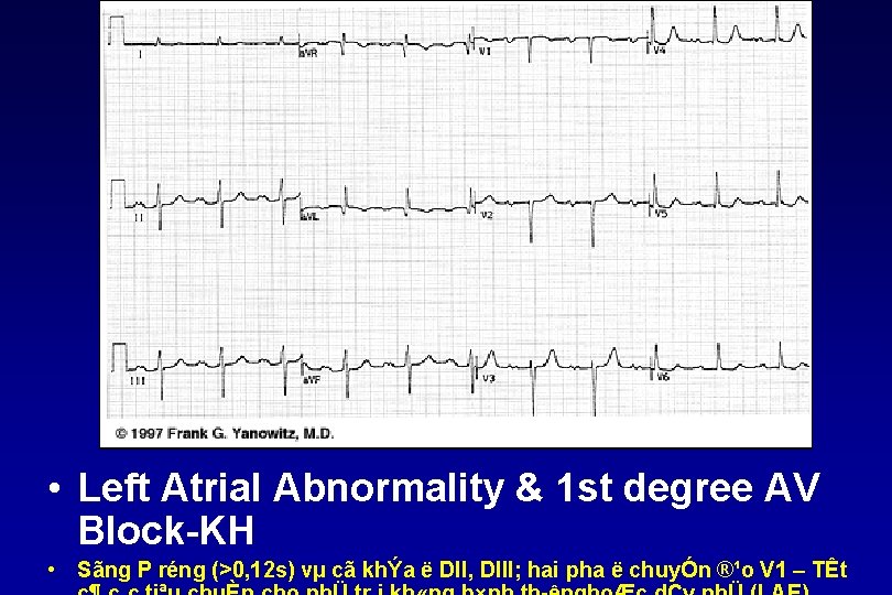  • Left Atrial Abnormality & 1 st degree AV Block KH • Sãng