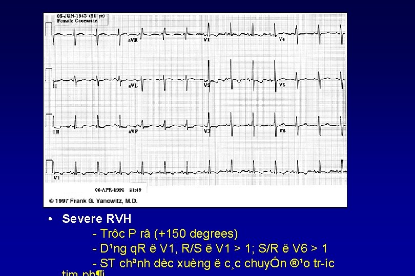  • Severe RVH Trôc P râ (+150 degrees) D¹ng q. R ë V