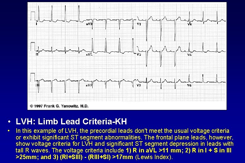  • LVH: Limb Lead Criteria KH • In this example of LVH, the