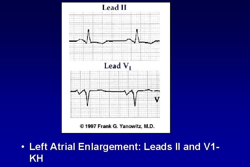  • Left Atrial Enlargement: Leads II and V 1 KH 