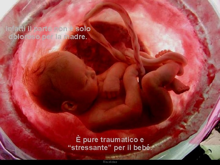 Infatti il parto non è solo doloroso per la madre. È pure traumatico e