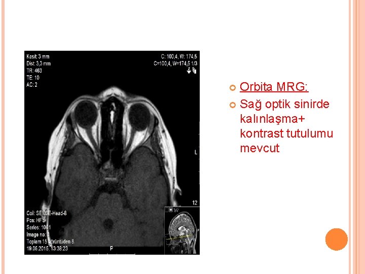 Orbita MRG: Sağ optik sinirde kalınlaşma+ kontrast tutulumu mevcut 