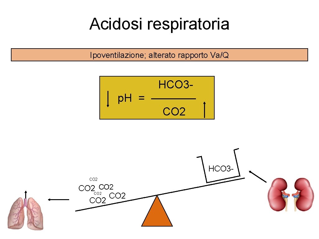 Acidosi respiratoria Ipoventilazione; alterato rapporto Va/Q HCO 3 p. H = ———— CO 2