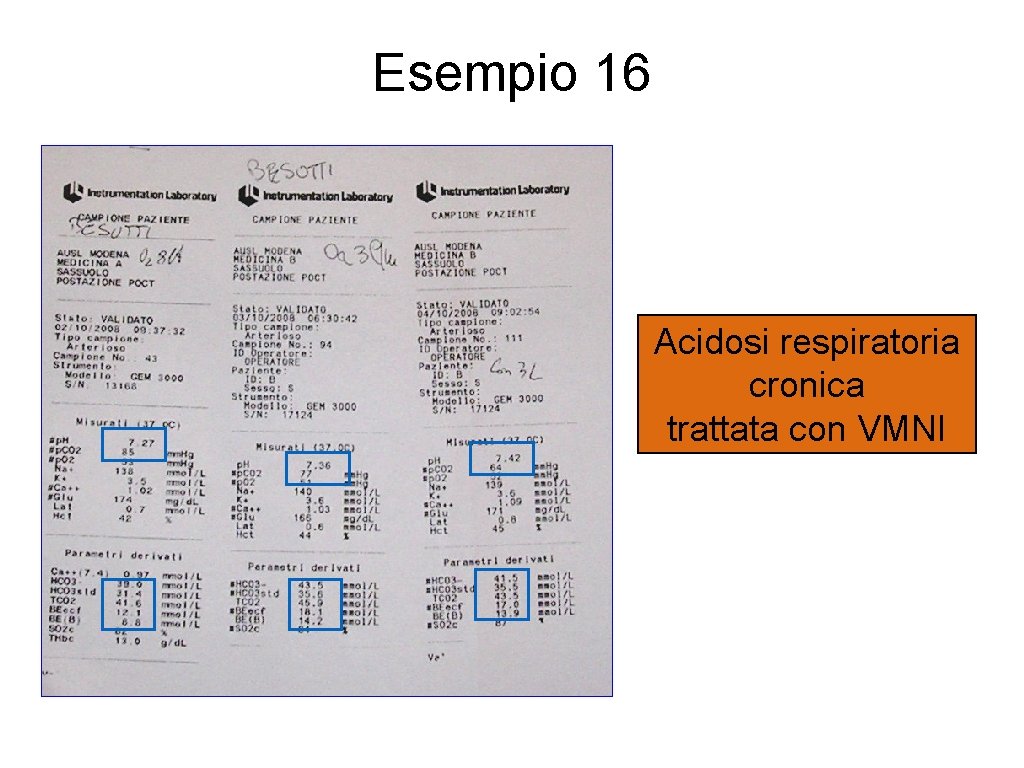 Esempio 16 Acidosi respiratoria cronica trattata con VMNI 