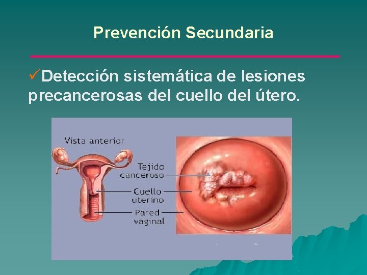 Prevención Secundaria üDetección sistemática de lesiones precancerosas del cuello del útero. 