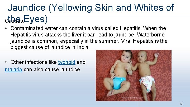 Jaundice (Yellowing Skin and Whites of the Eyes) Causes: • Contaminated water can contain