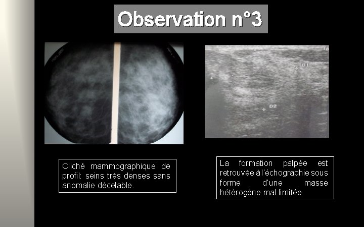 Observation n° 3 Cliché mammographique de profil: seins très denses sans anomalie décelable. La