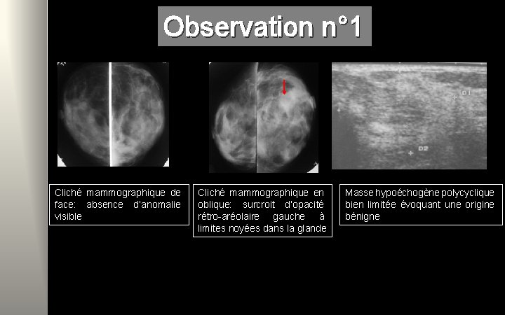 Observation n° 1 Cliché mammographique de face: absence d’anomalie visible Cliché mammographique en oblique: