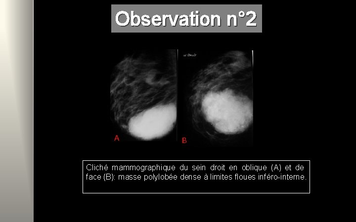 Observation n° 2 A B Cliché mammographique du sein droit en oblique (A) et