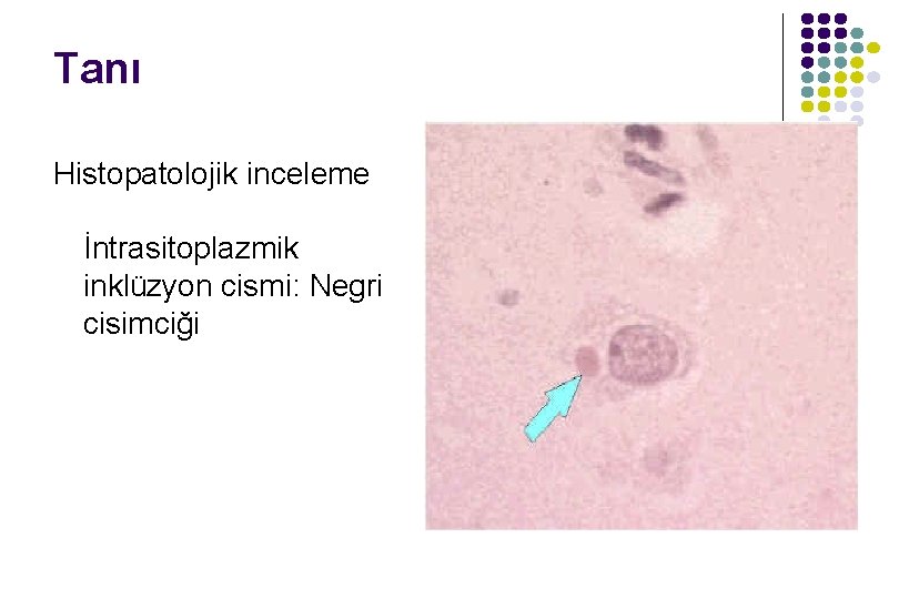 Tanı Histopatolojik inceleme İntrasitoplazmik inklüzyon cismi: Negri cisimciği Tanı Histopatolojik inceleme İntrasitoplazmik inklüzyon cismi: Negri cisimciği