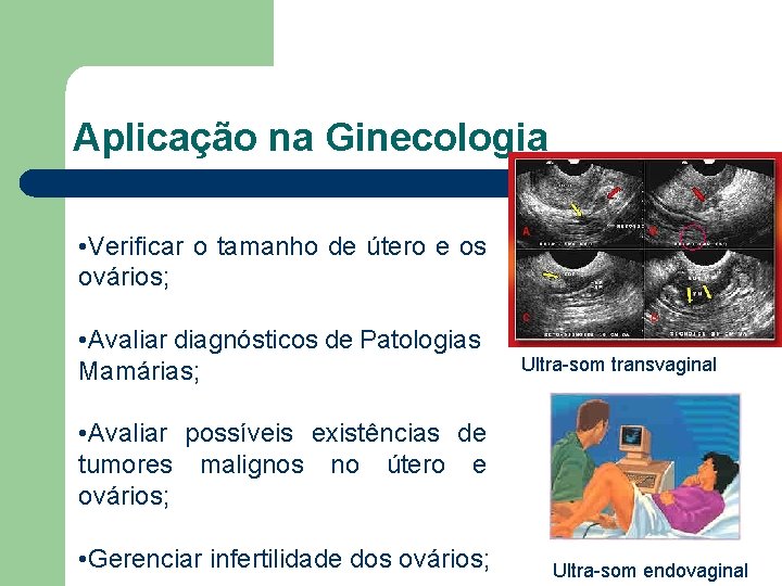 Aplicação na Ginecologia • Verificar o tamanho de útero e os ovários; • Avaliar