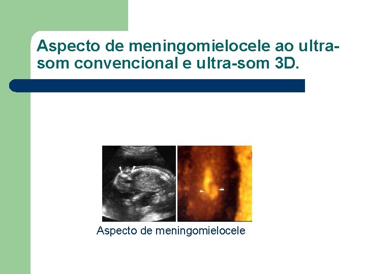 Aspecto de meningomielocele ao ultrasom convencional e ultra-som 3 D. Aspecto de meningomielocele 