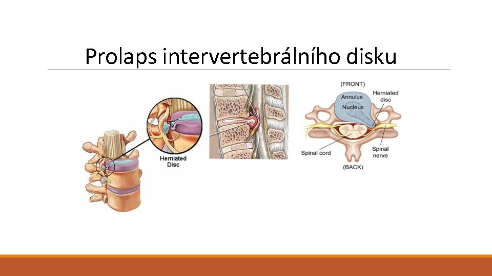 Prolaps intervertebrálního disku 