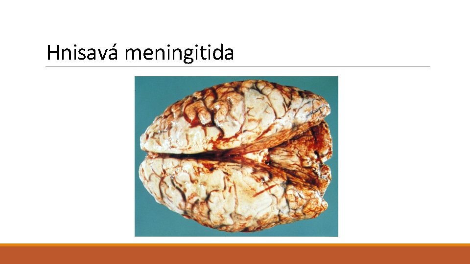 Hnisavá meningitida 