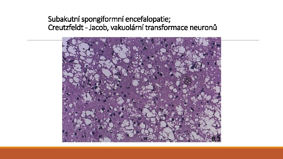 Subakutní spongiformní encefalopatie; Creutzfeldt - Jacob, vakuolární transformace neuronů 