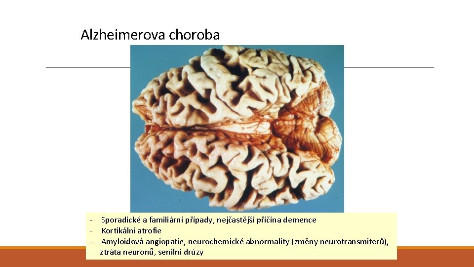 Alzheimerova choroba - Sporadické a familiární případy, nejčastější příčina demence - Kortikální atrofie - Alzheimerova choroba - Sporadické a familiární případy, nejčastější příčina demence - Kortikální atrofie -