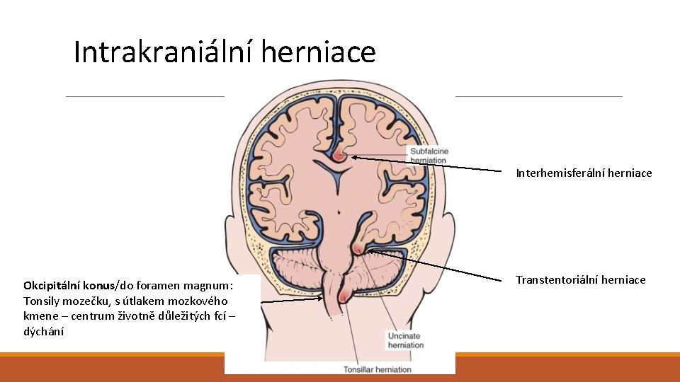 Intrakraniální herniace Interhemisferální herniace Okcipitální konus/do foramen magnum: Tonsily mozečku, s útlakem mozkového kmene Intrakraniální herniace Interhemisferální herniace Okcipitální konus/do foramen magnum: Tonsily mozečku, s útlakem mozkového kmene