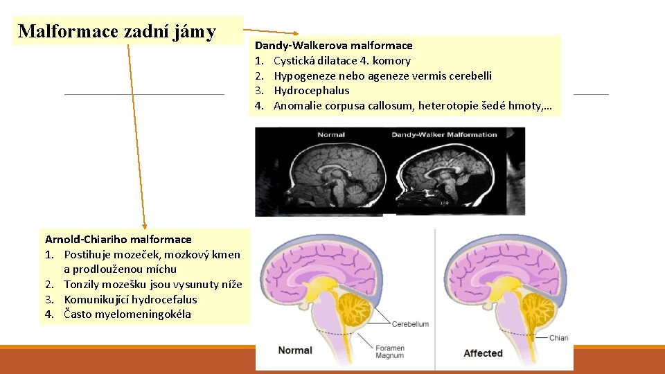Malformace zadní jámy Arnold-Chiariho malformace 1. Postihuje mozeček, mozkový kmen a prodlouženou míchu 2.