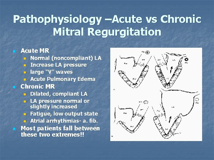 Pathophysiology –Acute vs Chronic Mitral Regurgitation n Acute MR n n n Chronic MR