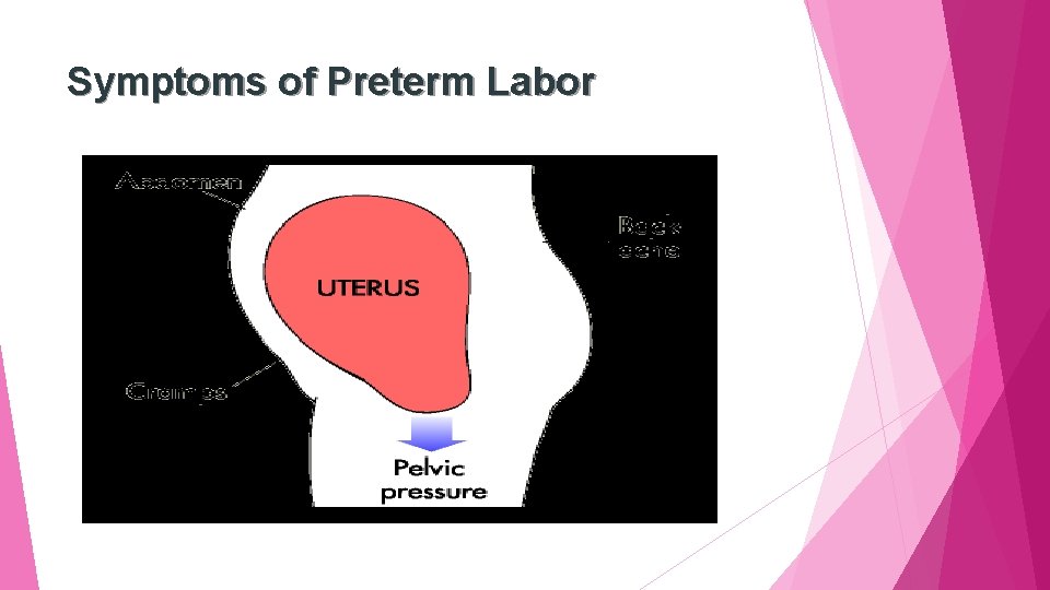 Symptoms of Preterm Labor 