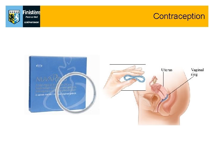 Contraception Contraception