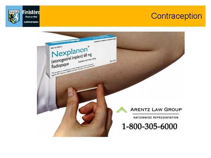 Contraception Contraception