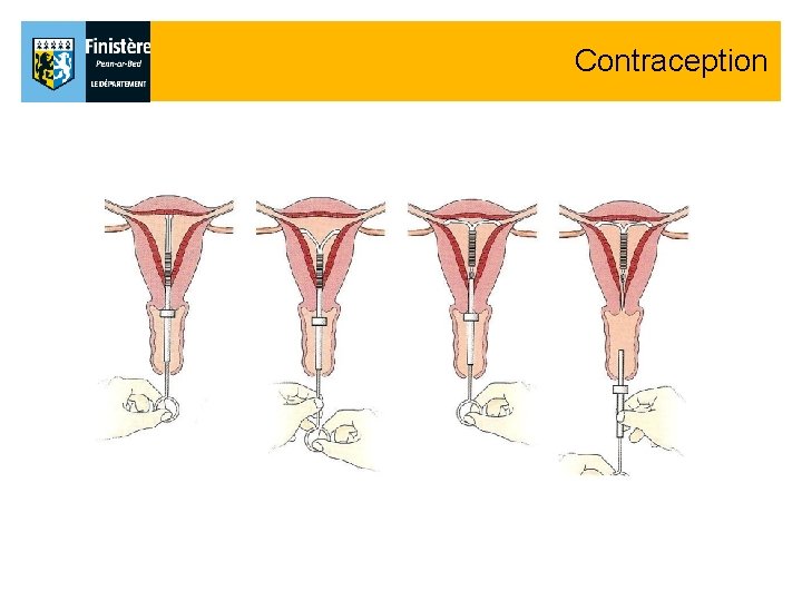 Contraception Contraception
