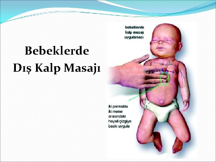 Bebeklerde Dış Kalp Masajı 